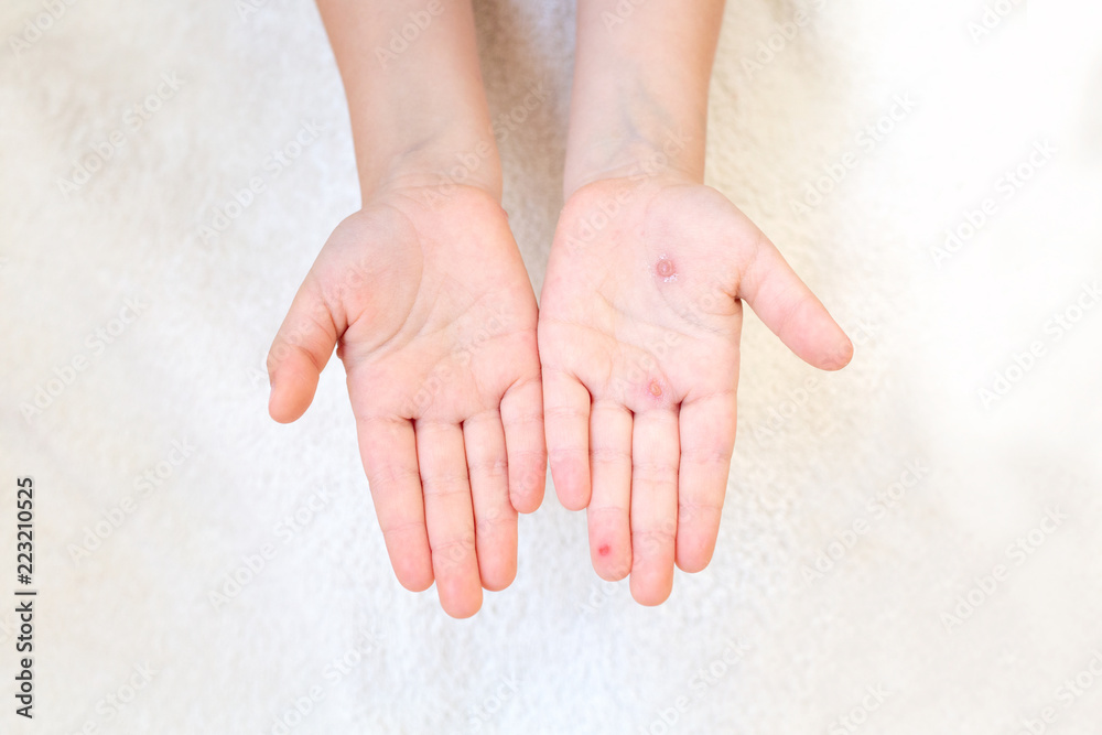 The hand of a child with chickenpox in her mother's hand. Blisters on ...