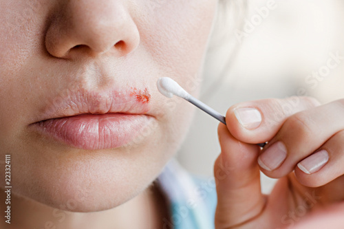 Part of a young woman's face with a virus herpes on lips, treatment with ointment photo