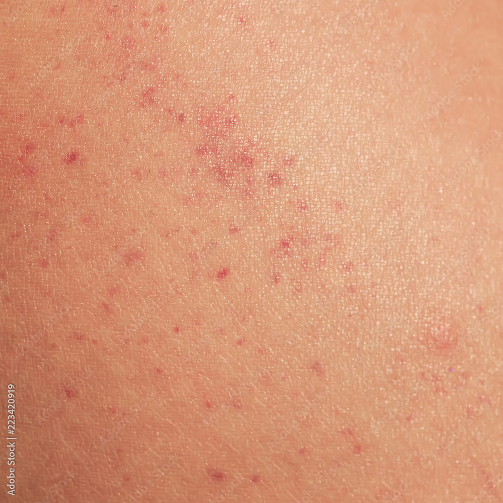 sick human skin texture covered with red allergic spots and irritations