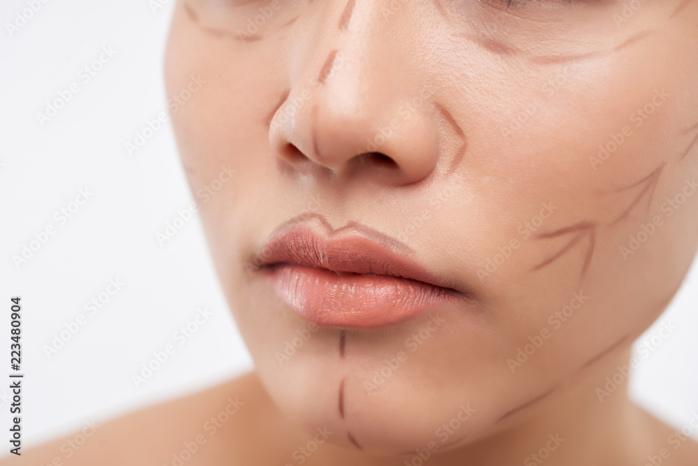 Close-up image of female face with surgical lines Close-up image of female face with surgical lines