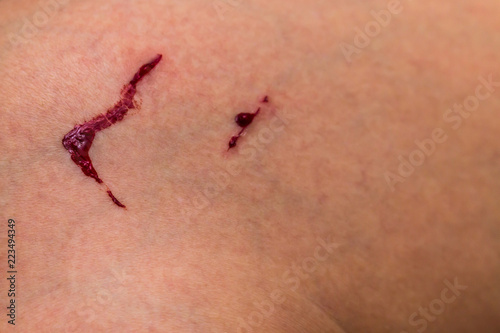 Bleeding wound in the leg