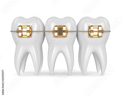 3d render of teeth with golden orthodontic braces photo