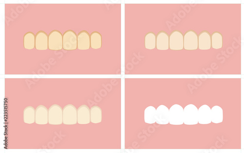 Vector image of the stages of teeth whitening