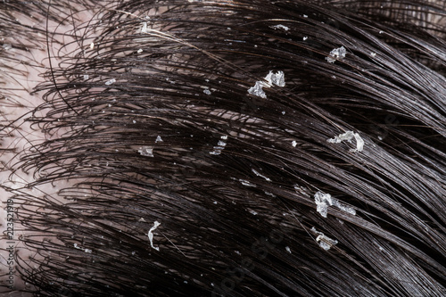 Dandruff on her dark hair