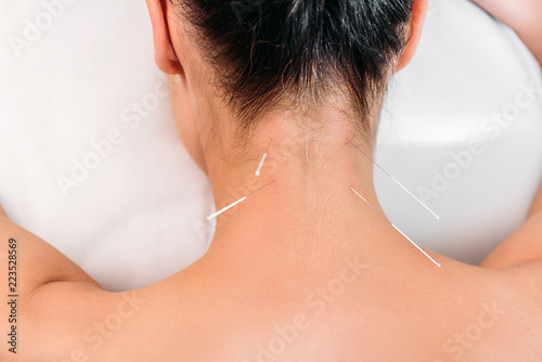 partial view of woman having acupuncture therapy in spa salon