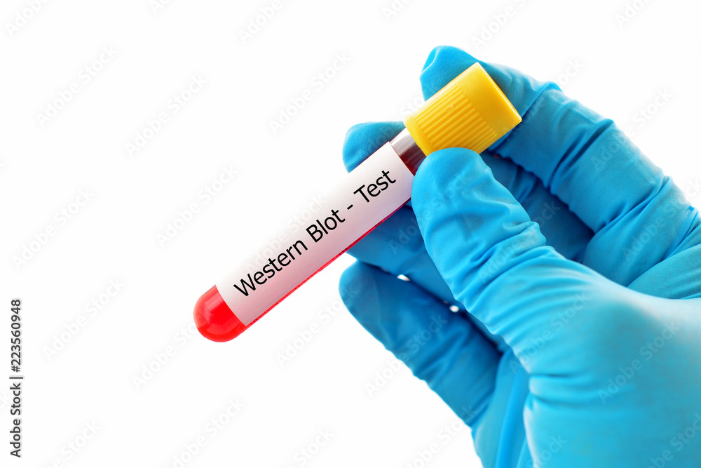 Blood sample tube for Western blot test, confirmatory test for HIV infection Stock Photo Adobe
