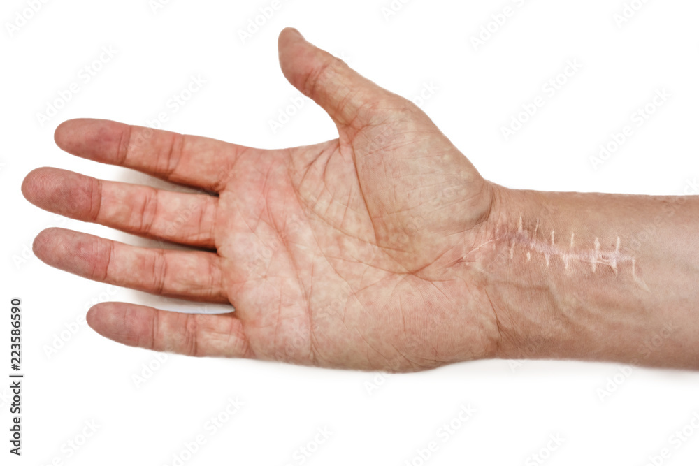 Scar with stitches on the wrist after surgery. Fracture of the bones of the hands isolated on white background