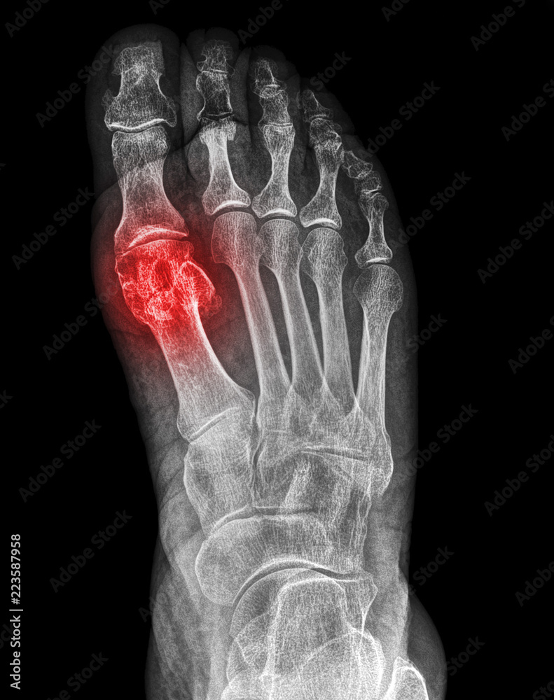 Xray fracture of the first metatarsal bone Stock Photo Adobe Stock