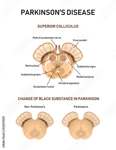 Midbrain anatomy. Parkinson's disease photo