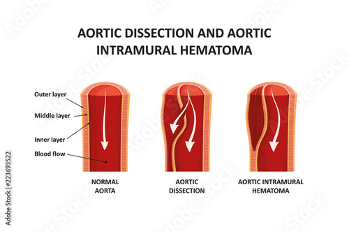 Aortic dissection and aortic intramural hematoma