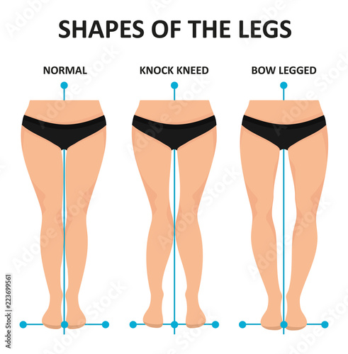 Types of curvatures human feet.