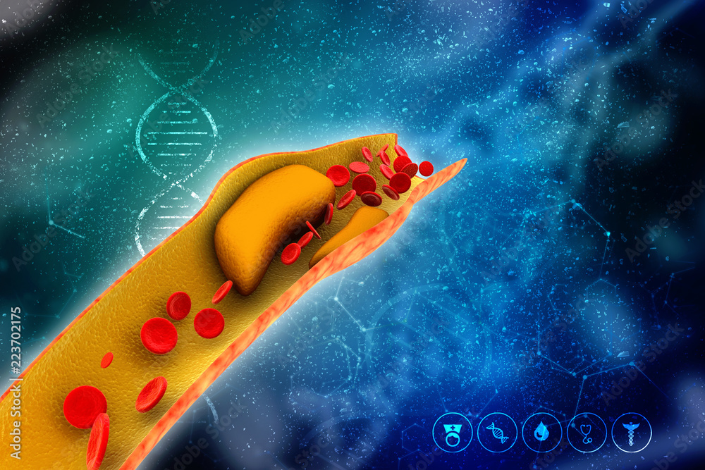 3d rendering blood cells with plaque buildup of cholesterol symbol of ...