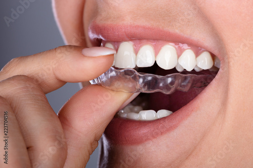 Woman Putting Transparent Aligner In Teeth