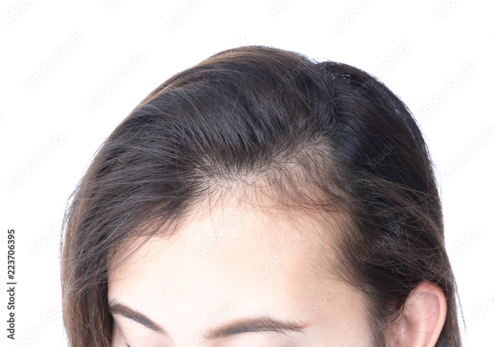 Woman serious hair loss problem for health care shampoo and beauty product concept Woman serious hair loss problem for health care shampoo and beauty product concept