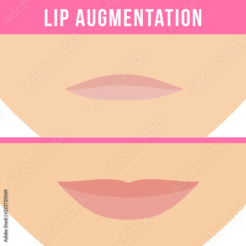Woman makes procedure of beauty injection for lip augmentation. Lips before and after hyaluronic acid lip filler injection. Vector