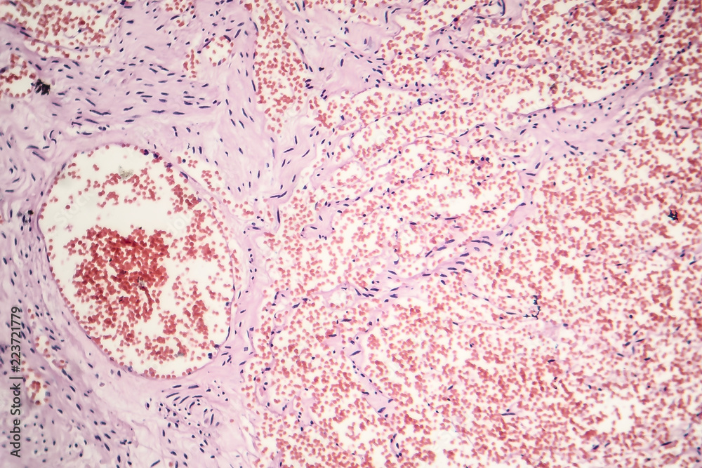 Capillary Hemangioma