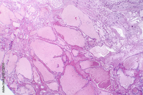 Hepatic cavernous hemangioma, a benign liver tumor, light micrograph, photo under microscope photo