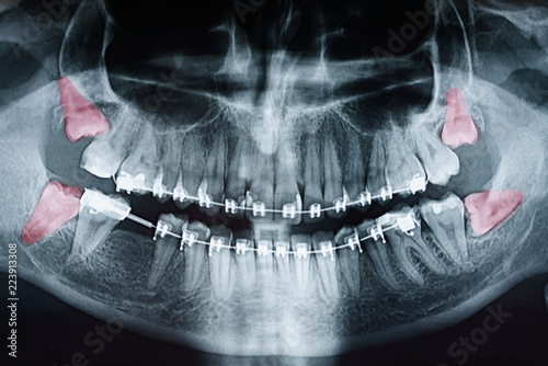 Rosnący ból zębów mądrości na zdjęciu rentgenowskim