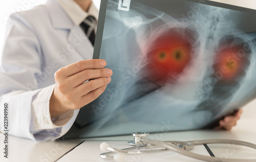 radiology x-ray lung cancer