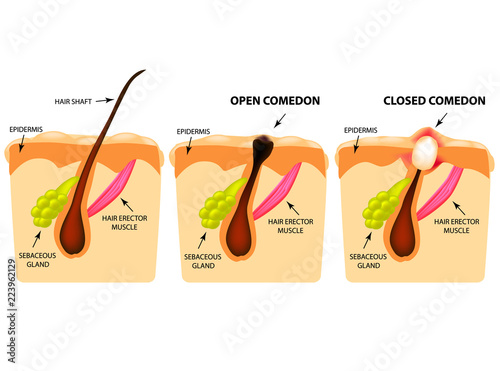 Types of acne. Open comedones, closed comedones, Skin structure. Infographics. Vector illustration on isolated background