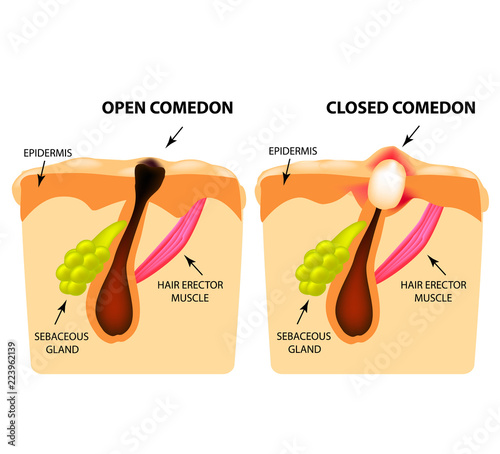 Types of acne. Open comedones, closed comedones, Skin structure. Infographics. Vector illustration on isolated background
