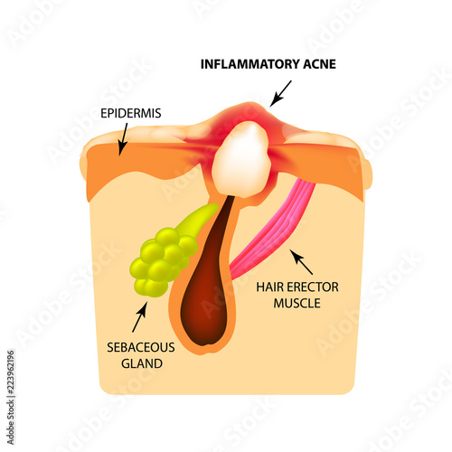 Inflammatory comedones. acne. The structure of the skin. Infographics. Vector illustration on isolated background