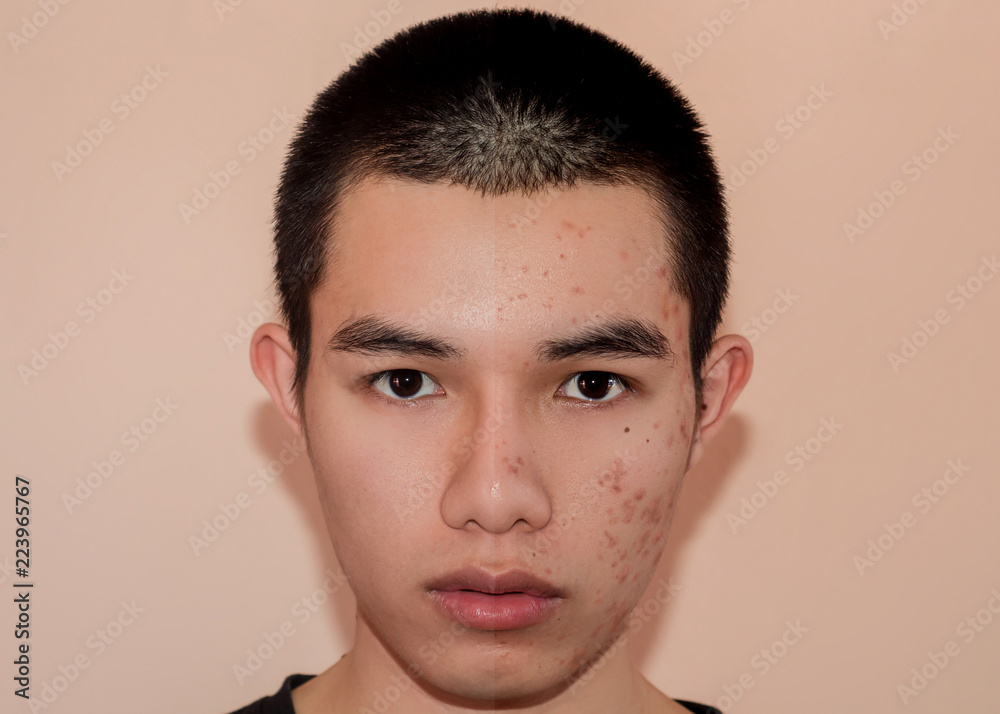 Obraz premium Young man with before and after treatment from acne and pimple by removal acne.