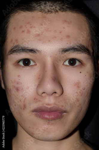 The scars and wrinkle caused by acne and pimple on skin by Hormone or grime.