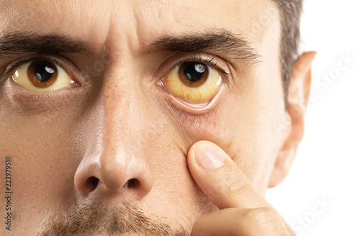 Yellowish eyes is sign of problems with liver, viral infection or other disease photo
