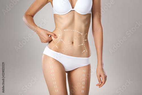 Woman torso in underwear with medical marks for plastic surgery or liposuction photo