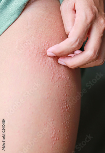 Allergic rash dermatitis eczema on skin. Hand scratching.