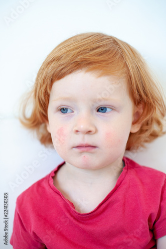 Allergies, atopic dermatitis on the face of a baby