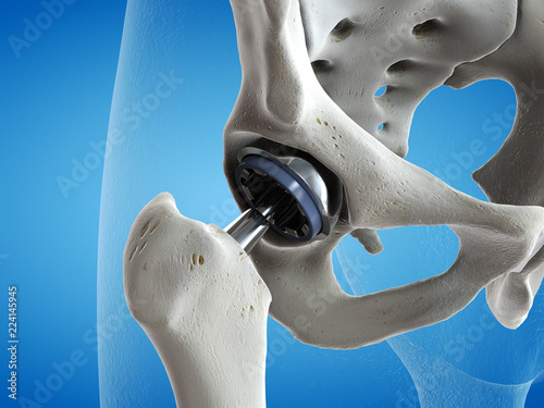 Canvastavla 3d rendered medically accurate illustration of a hip replacement