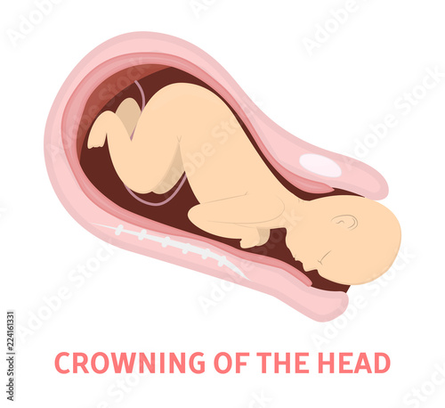 Crowning stage of baby birth in vaginal delivery