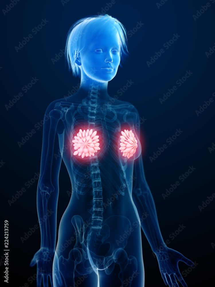 3d rendered medically accurate illustration of an inflamed mammary glands