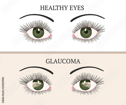 Eye disease. Ophthalmology health illustration.