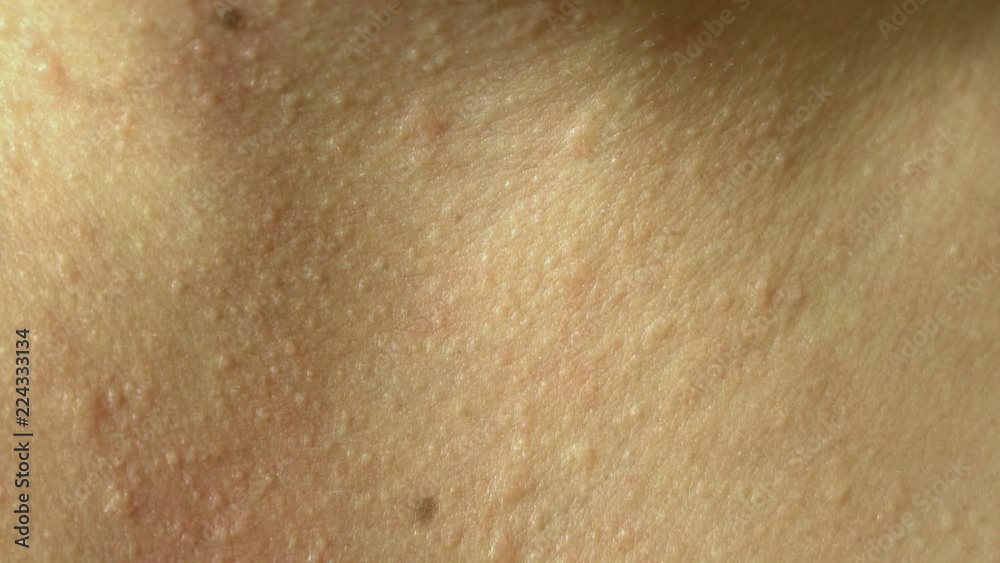 Woman scratch the itch with hand, Neck. Red spots on the neck, allergies, psoriasis, insect bite. Malaria. Sunburn. Sun burn Woman scratch the itch with hand, Neck. Red spots on the neck, allergies, psoriasis, insect bite. Malaria. Sunburn. Sun burn