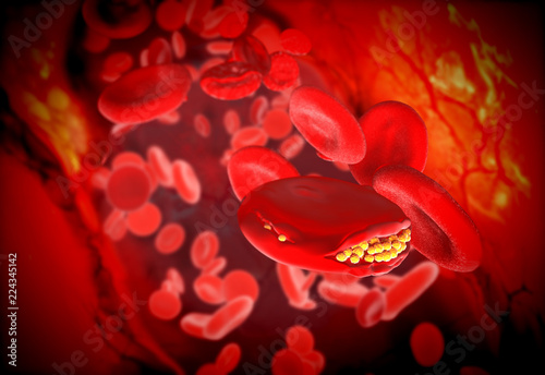 Fotografie Cholesterol plaque in blood vessel