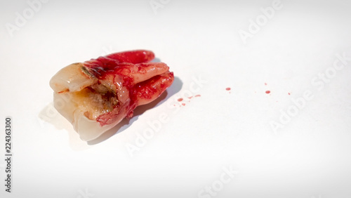 Extracted Bloody Tooth with Severe Dental Decay.