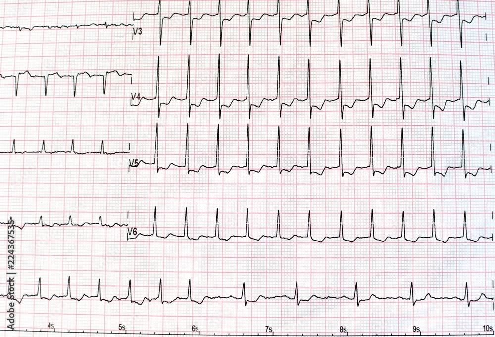 Top view of an electrocardiogram in printed paper form for health care and medical concept. EKG or ECG paper background Top view of an electrocardiogram in printed paper form for health care and medical concept. EKG or ECG paper background