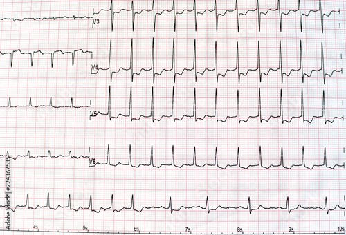 Top view of an electrocardiogram in printed paper form for health care and medical concept. EKG or ECG paper background