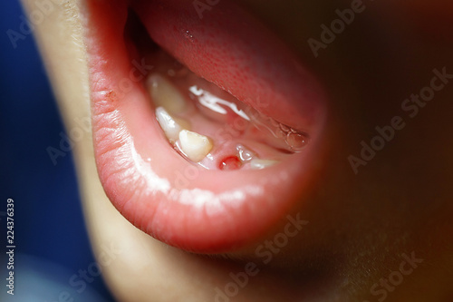 photo story about the boy who had the first baby tooth