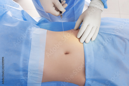 procedure for laser lipolysis of the abdominal region.