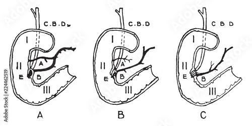 Variations in Termination of the Pancreatic and Bile Ducts, vintage illustration.
