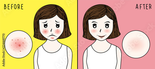 vector woman face. acne before and after. skin care illustration.