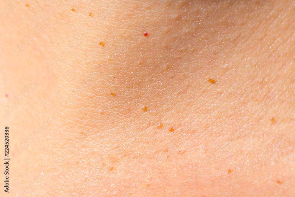 Closeup of several fibromas and birthmarks on the skin of a young caucasian woman 