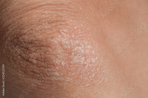 Canvas Print Winterizing dry itchy skin on the elbow area