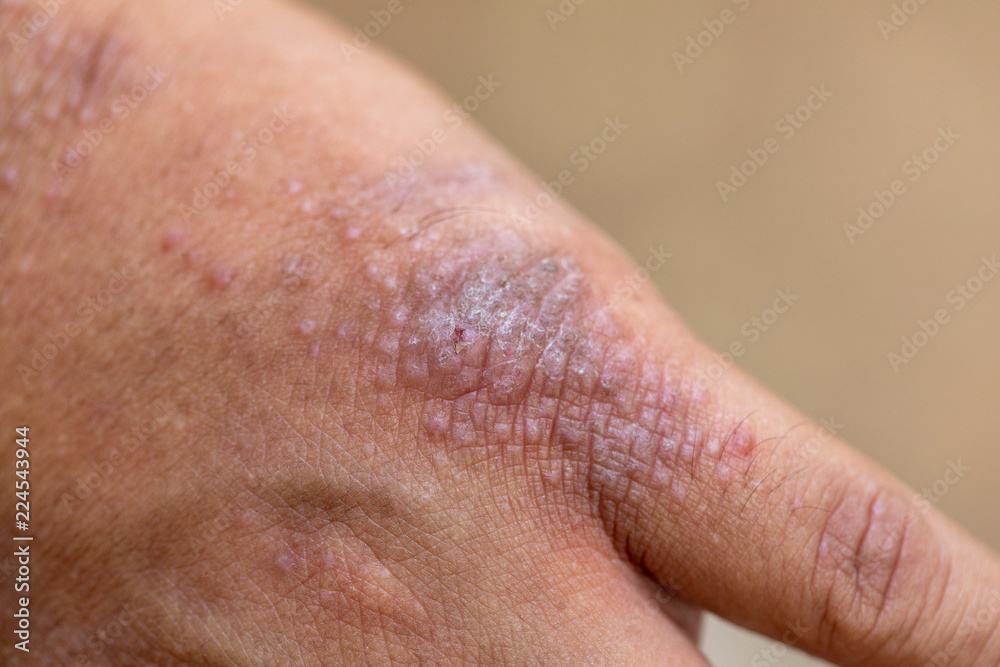 A physical of Atopic dermatitis (AD), also known as atopic eczema, is a type of inflammation of the skin (dermatitis). A physical of Atopic dermatitis (AD), also known as atopic eczema, is a type of inflammation of the skin (dermatitis).