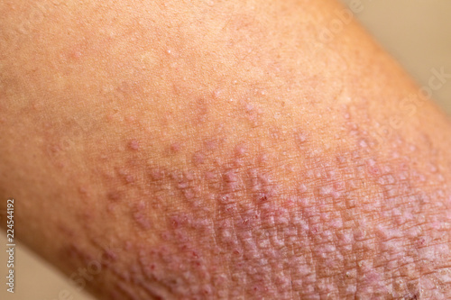 A physical of Atopic dermatitis (AD), also known as atopic eczema, is a type of inflammation of the skin (dermatitis).