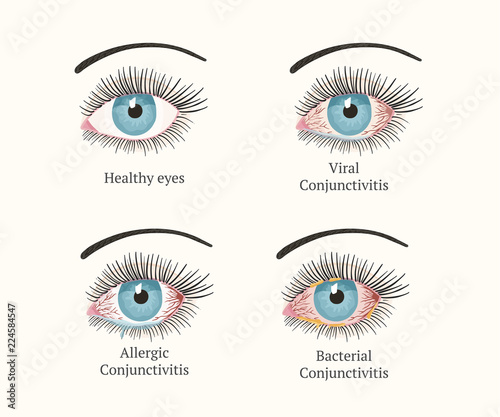 Eye disease. Ophthalmology health illustration.